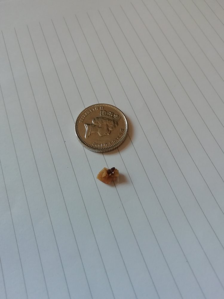 Kidney stone july 2021.jpg