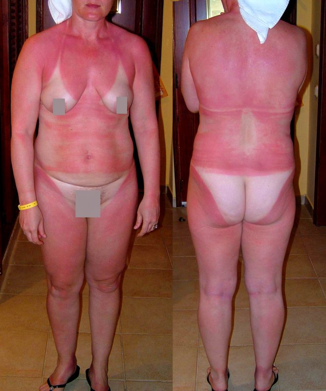 Naked_heavily_burnt_female_body..jpg