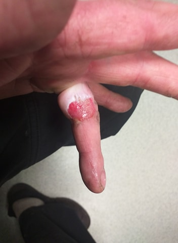 PLASMA BURN1.png
